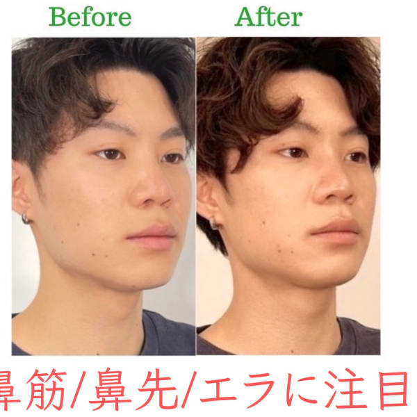 【鼻筋を高く】お悩み別ビフォーアフター|隆鼻矯正専門店 Raplit 福岡天神店　美鼻・小顔矯正・輪郭矯正