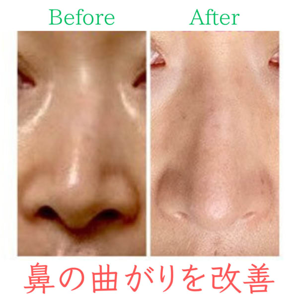 【鼻の曲がり】お悩み別ビフォーアフター|隆鼻矯正専門店 Raplit 福岡天神店　美鼻・小顔矯正・輪郭矯正