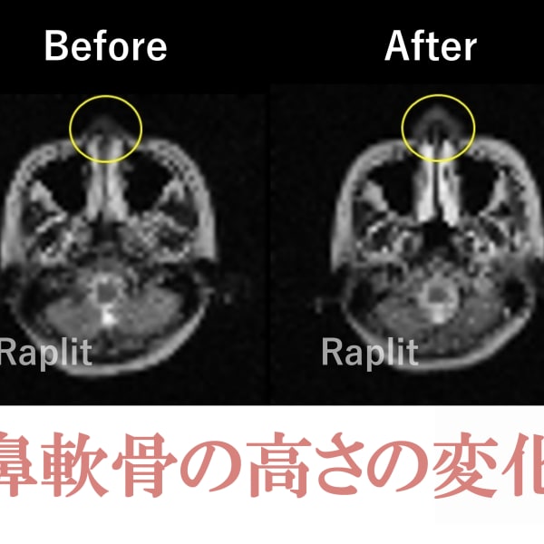 【MRI画像】ビフォーアフター|隆鼻矯正専門店 Raplit 福岡天神店　美鼻・小顔矯正・輪郭矯正