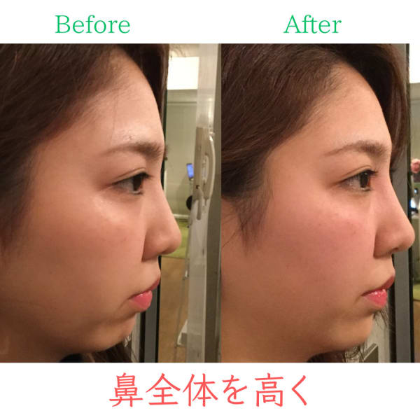 【鼻全体高く】お悩み別ビフォーアフター|隆鼻矯正専門店 Raplit 広島八丁堀 美鼻・小顔矯正・毛穴洗浄(ラプリ)