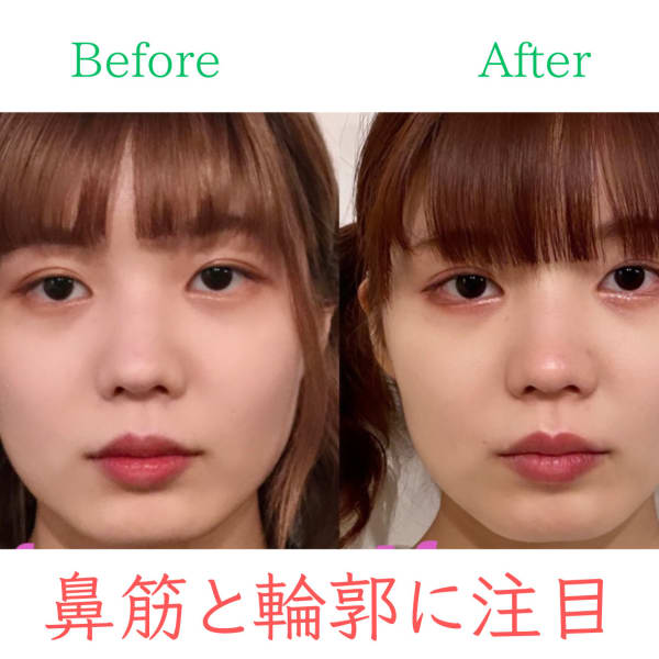 【輪郭・小顔】お悩み別ビフォーアフター|隆鼻矯正専門店 Raplit 広島八丁堀 美鼻・小顔矯正・毛穴洗浄(ラプリ)