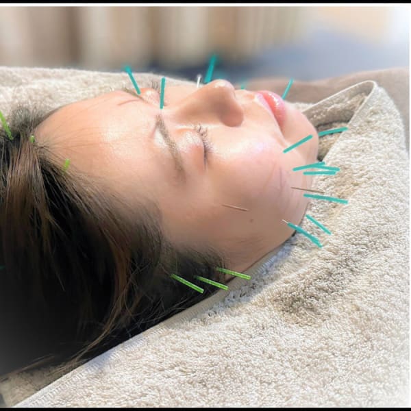 【大人気　美容鍼】　初めての方、美容鍼の効果できれいになりたい方おすすめ◎|NAORU整体 仙台院