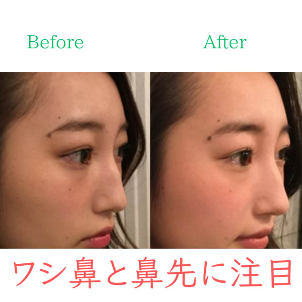 【ワシ鼻を修繕】お悩み別ビフォーアフター|隆鼻矯正専門店 Raplit 福岡久留米店
