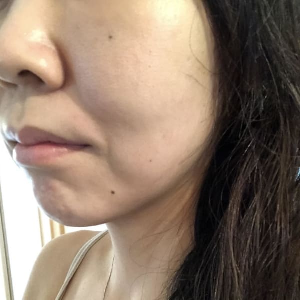 年齢肌によるたるみのお悩みに安心の施術|parafuse.nalu