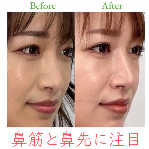 【鼻先を高く細く】お悩み別ビフォーアフター|隆鼻矯正専門店Raplit 福岡久留米店