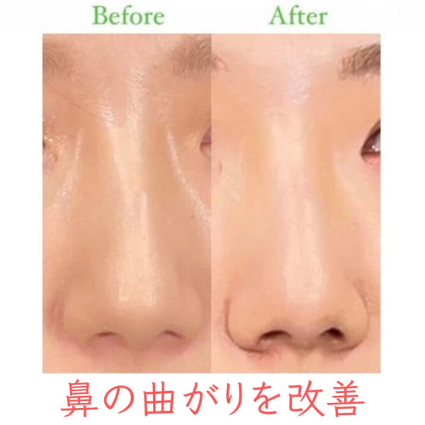 【鼻の曲がり】お悩み別ビフォーアフター|隆鼻矯正専門店Raplit 福岡久留米店
