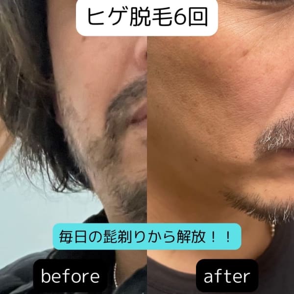 脱毛サロン併設で　カットと同時日に施術可能|DUPEHAIR