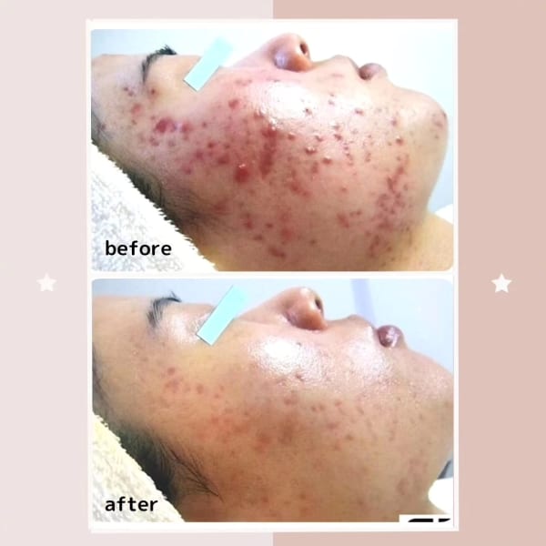 毛穴・ニキビ・ニキビ跡レスな肌を手に入れる！肌質を変えることができるサロン|レゾン 京橋店