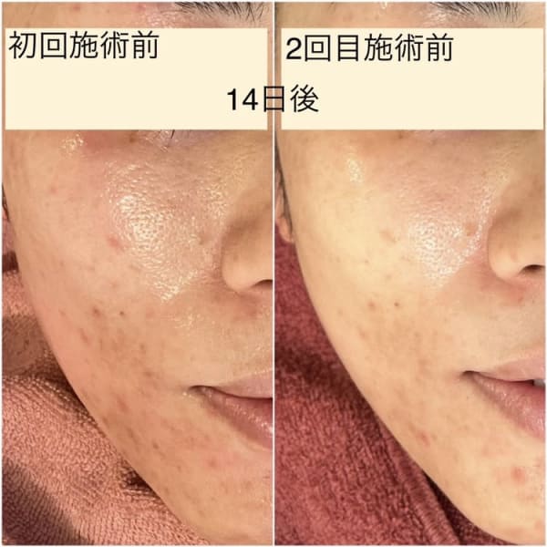 驚愕価格!!　新規登録【シミプラズマ3回コース￥8,800】|flur恵比寿店