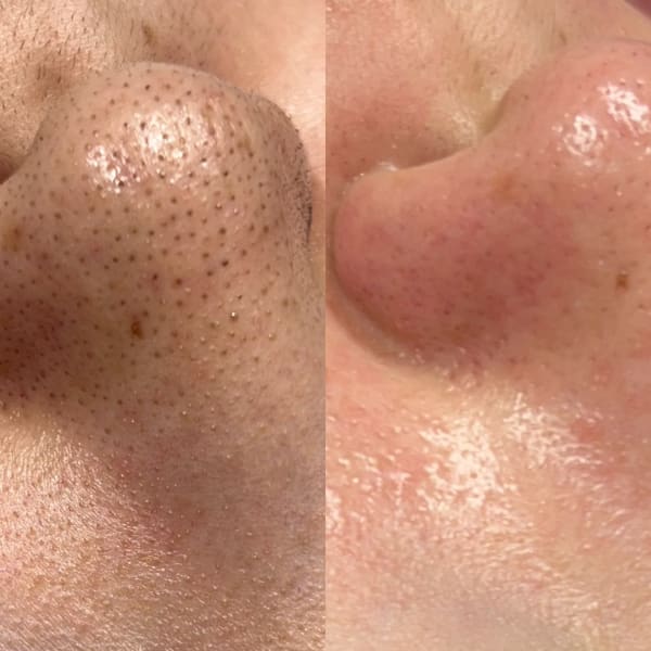 SNSで話題☆韓国式3D毛穴洗浄|BEYOND L’INK