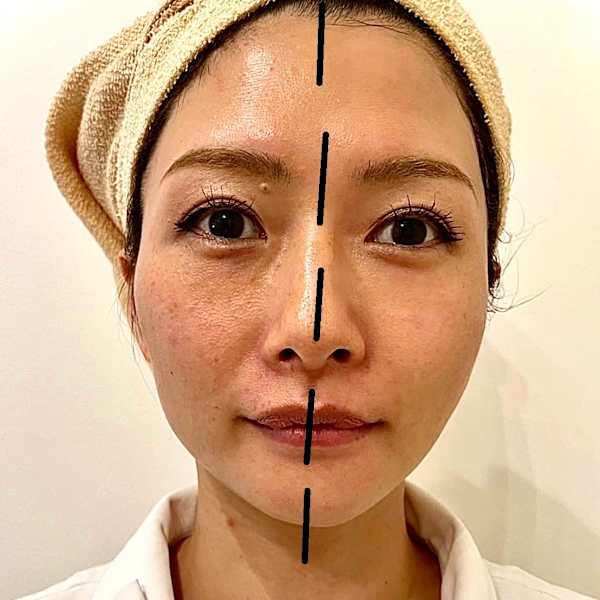 【オキシジェネオ×小顔ハリフ】西宮で最安値★ハイフォト以上★くすみシミしわたるみ毛穴1度で改善|小顔ハイリフ ハーブピーリング 脱毛【スペチアーレ夙川】西宮