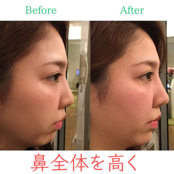 【鼻全体高く】お悩み別ビフォーアフター|隆鼻矯正専門店 Raplit 福岡博多店