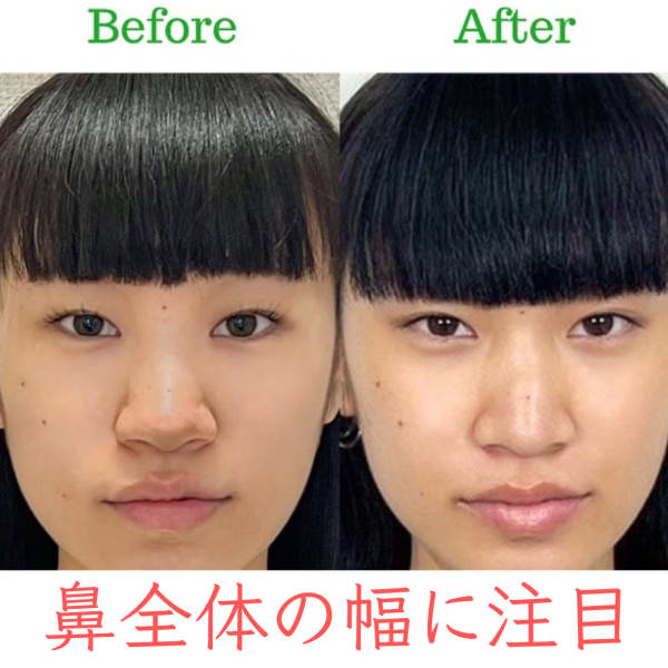 【小鼻を細く】お悩み別ビフォーアフター|隆鼻矯正専門店 Raplit 福岡博多店