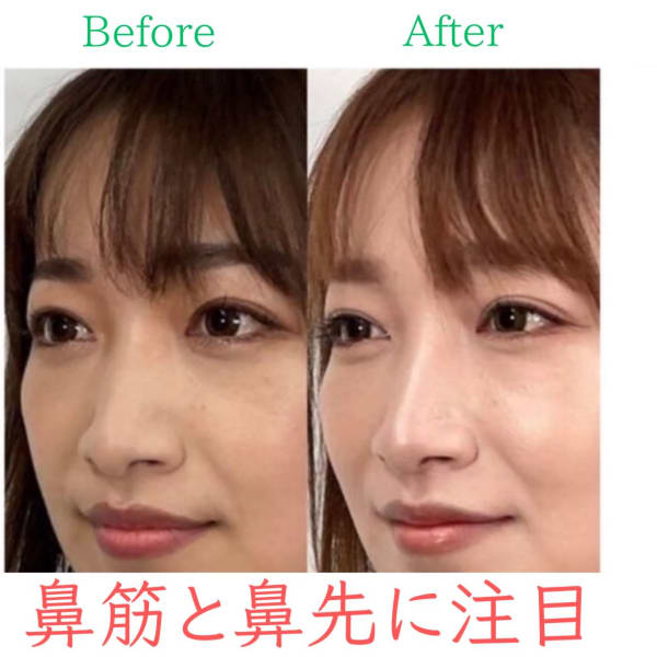 【鼻先を高く細く】お悩み別ビフォーアフター|隆鼻矯正専門店 Raplit 福岡博多店