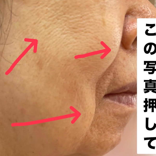 【西宮でハリフ1位】同業者が通うほど【このBeforeAfter見て♪】ハイフォト西宮1の低価格|小顔ハイリフ ハーブピーリング 脱毛【スペチアーレ夙川】西宮