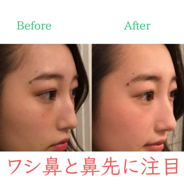 【ワシ鼻を修繕】お悩み別ビフォーアフター|隆鼻矯正専門店 Raplit 福岡博多店