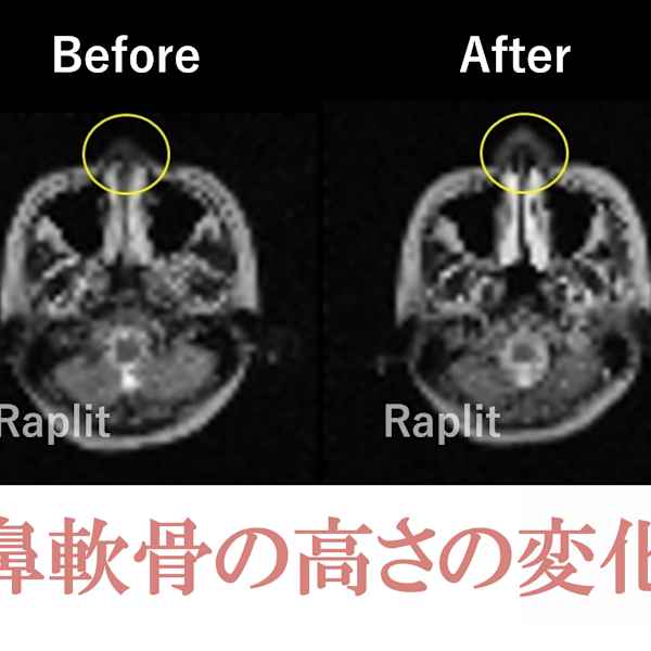 【MRI画像】ビフォーアフター|隆鼻矯正専門店 Raplit 福岡博多店