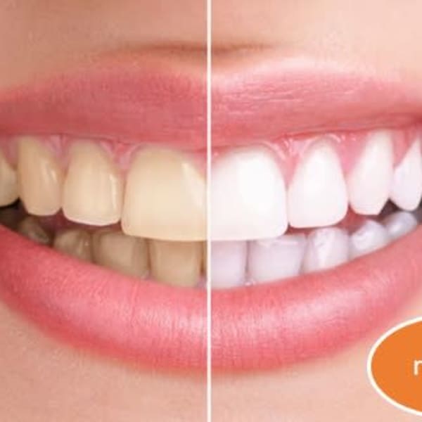 最新式サイクロン式照射!歯のホワイトニング!|La chou chou moi店