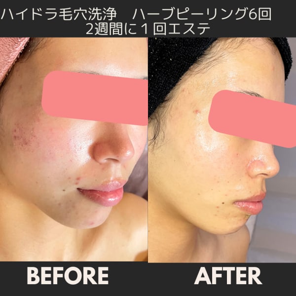 ２０代に人気！ニキビ　ニキビ跡に！ハーブピーリング|シミケア 肌質改善エステサロン chiffon