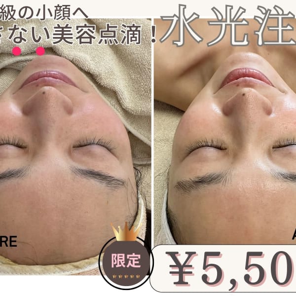 [当店リピ-ト率No.1]ノンニ-ドル水光注入で史上最強のリフトUPを実感!美容以上レベルの感動体験|肌質改善専門サロン MavY. 樟葉店