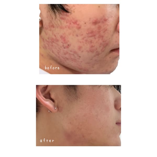 エンビロンでニキビ・脂性肌改善へ|Madame VISAGE