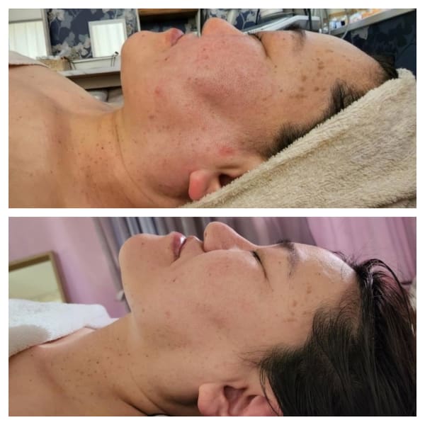 【体重の変化ゼロ】WINBACK ヘッドスパ2回の変化。頭皮の毛細血管と頭の皮膚の正常化が全身に影響|Miel et Fleurs