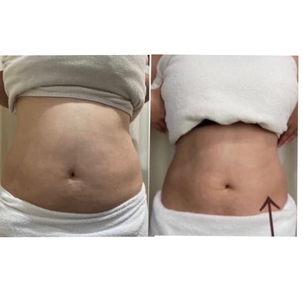 腰回りのハミ肉、パンパンに張ったポッコリお腹!!内臓が冷えると代謝も低下し痩せづらいお身体に|Miel et Fleurs