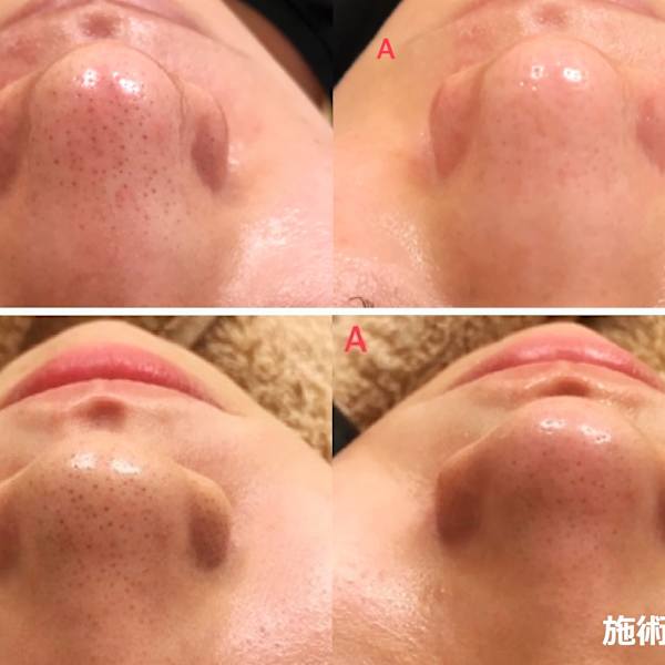 ビフォーアフター【美肌再生脱毛:顔脱毛+フェイシャル】|顔脱毛 VIO脱毛 美顔 都度払い【ナチュレ&メディカ】