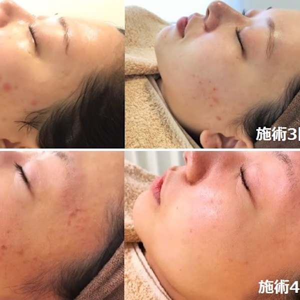 ビフォーアフター【美肌再生フェイシャル:光フォト+フェイシャル】|顔脱毛 VIO脱毛 美顔 都度払い【ナチュレ&メディカ】