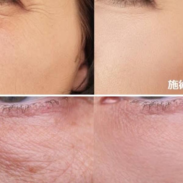 ビフォーアフター【プラズマ】、【カーボン】|顔脱毛 VIO脱毛 美顔 都度払い【ナチュレ&メディカ】