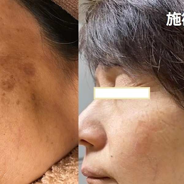 ビフォーアフター【YAG】|顔脱毛 VIO脱毛 美顔 都度払い【ナチュレ&メディカ】