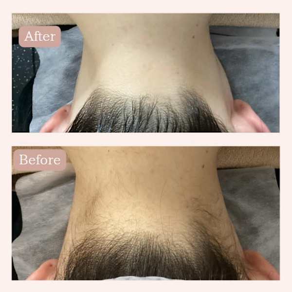 全身脱毛9900円~ 後ろ姿に自信をプラス。うなじ脱毛で魅力UP!|LEADepiA Private脱毛salon