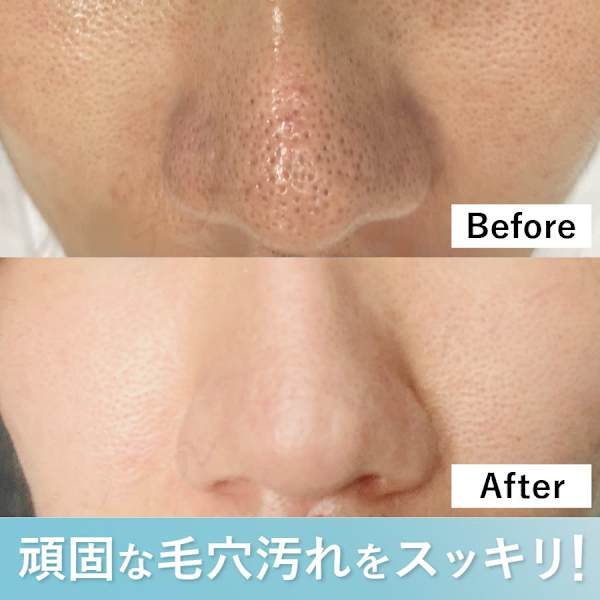 【毛穴汚れハイドロ集中洗浄】バクテリウムピール×ハイドロ洗浄でWアプローチ!ニキビ肌にも◎|デジール心斎橋店