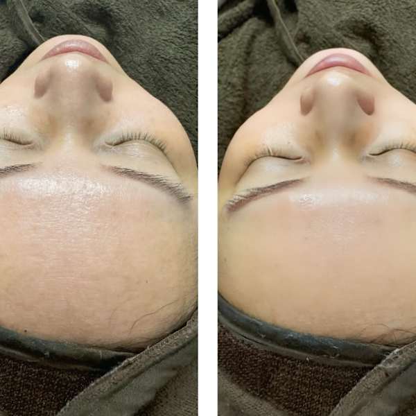 お肌のお悩み諦めていませんか？　お肌のお悩みを必ず改善します！|fleur