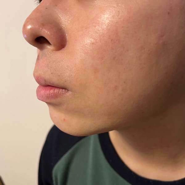 「ヒゲ脱毛」ひげ減毛のビフォーアフター|理容室 HAIR HANDS