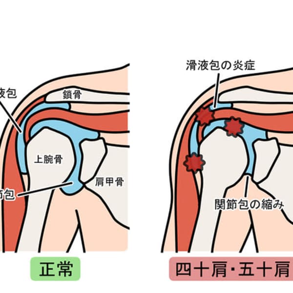 ◎四十肩・五十肩の原因と対処法・タイマッサージ|ヌアットタイ新大久保