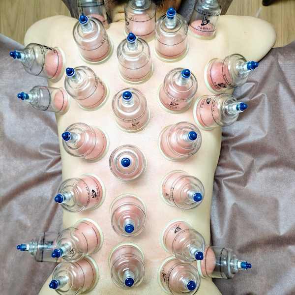 オイルカッピング　吸い玉療法|AsianHealingMango タイ古式とカッピングとアロマ