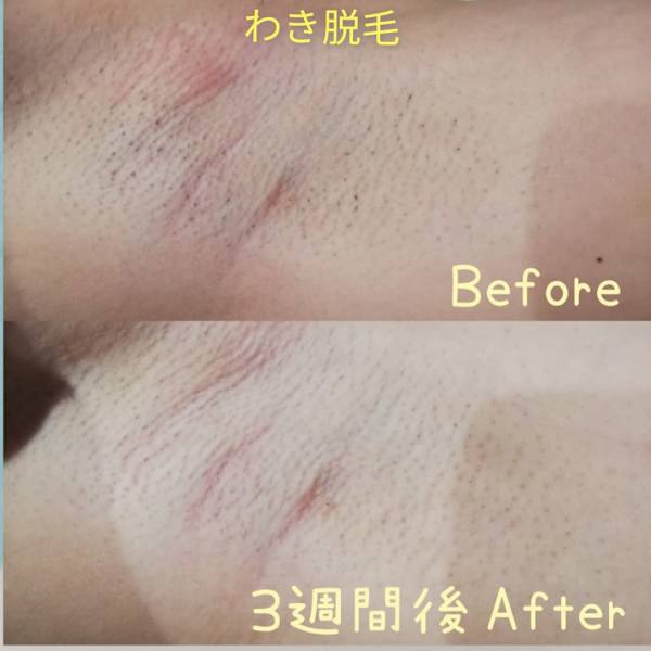 ツルツル肌で輝く自分!!2週間に一度のペースでできる速効脱毛で、夏を楽しもう!!|RiとBiのたまご(りとびのたまご)