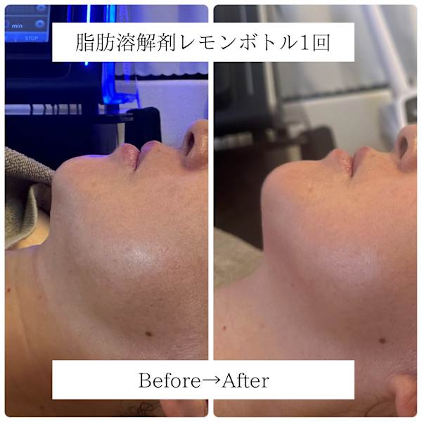 小顔・たるみ・フェイスライン◎脂肪溶解レモンボトル|Lino me