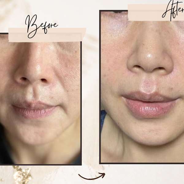 「ブログ」水光肌×エイジングケア|convince beauty esthetic