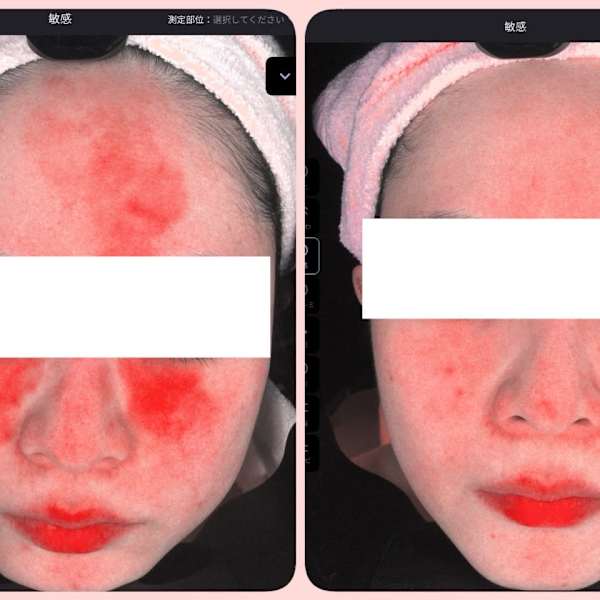 AI肌診断機導入★老化を先回りしてケアできる!|トータルビューティサロン Queen茅ヶ崎店