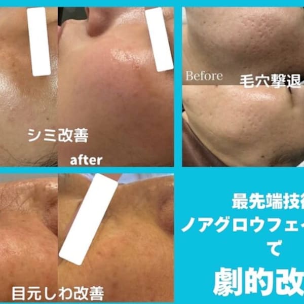 【マイクロニードル】お試しください。リフトアップ、しわケア、シミケア|リラクエステ希望