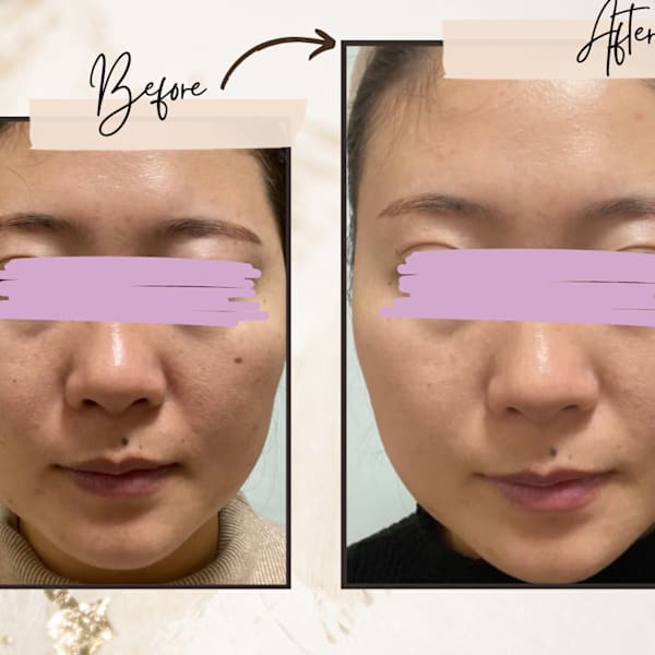 「ブログ」ピーリング×たるみケア|convince beauty esthetic