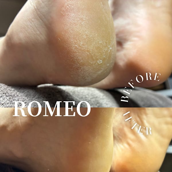 削るだけのフットケアとは仕上がりが全然違う！韓国式足裏角質ケアで、何度も触りたくなる滑らかな足裏へ|脱毛専門salon  Romeo