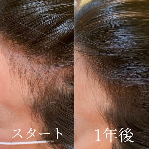 未来の美髪は頭皮から。細毛・抜け毛のお悩みにヒト幹細胞を使用した《強髪スカルプケア》がオススメ|nico hair