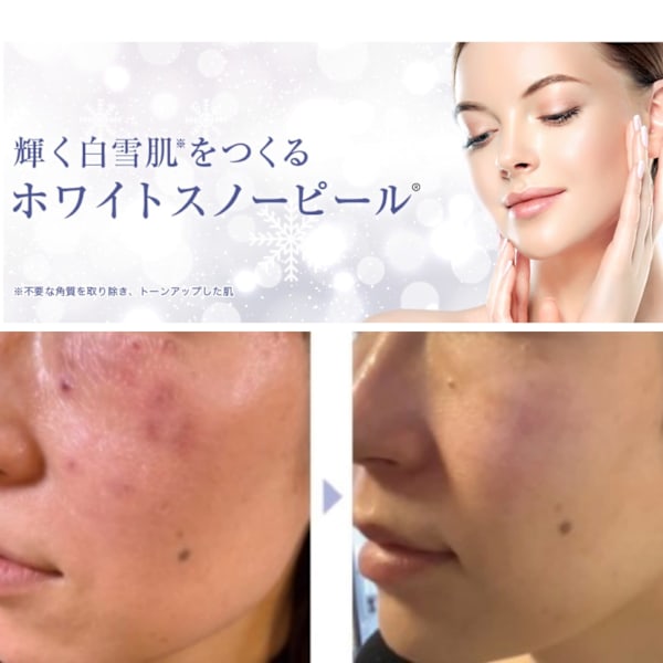 くすみやシミの改善、肌の滑らかさ《ホワイトニング　乳酸ピーリング》の効果と安全性|40歳からのエイジンサロン Raj Path ラージ パトゥ