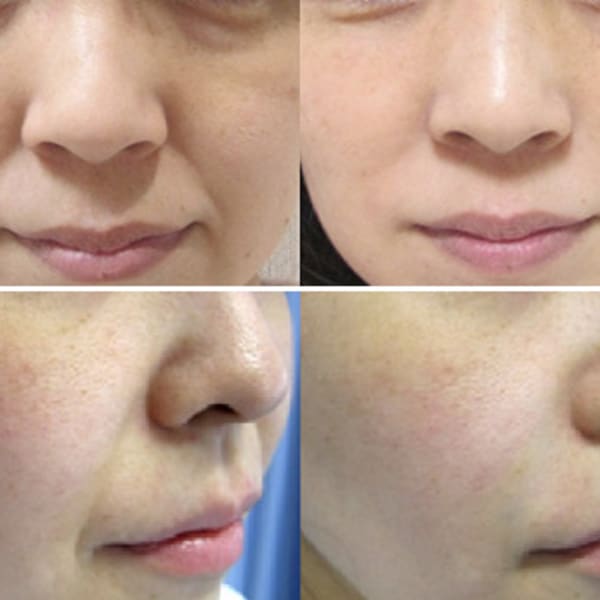 ビフォーアフター【RFリフトアップ】|顔脱毛 VIO脱毛 美顔 都度払い【ナチュレ&メディカ】