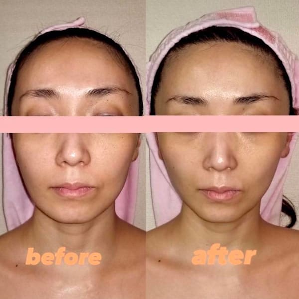 【タルミ改善&小顔】乳酸ピーリング+高濃度美容剤肌深部に導入+高周波リフト 初回110分¥9800円|小顔・美肌・マシン痩身 ルージュ恵比寿