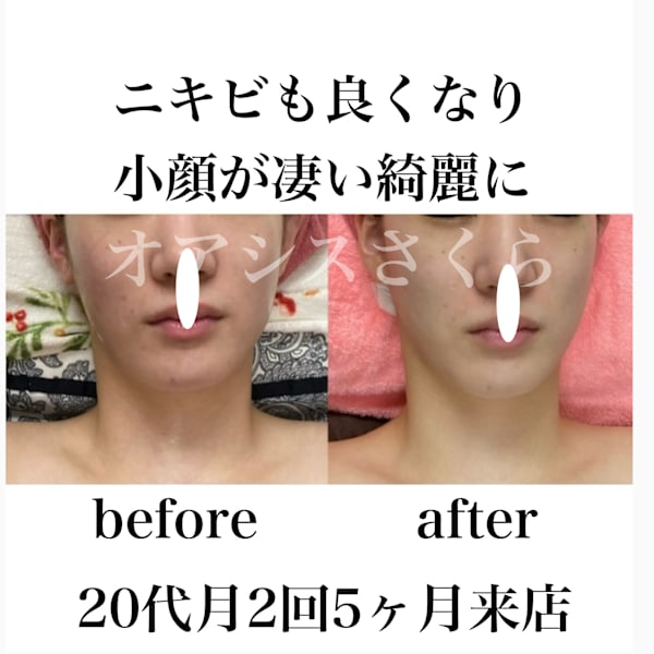 ニキビ跡も良くなりリフトアップ美しく華やかに|オアシス・さくら