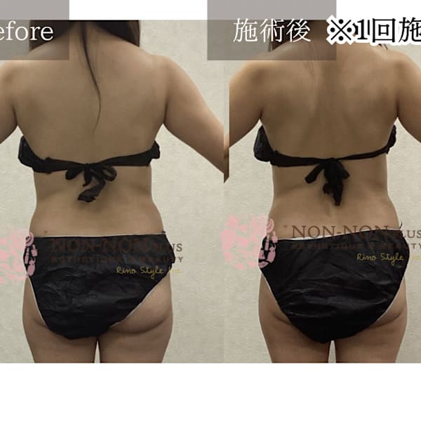 自分では痩せられない…でも1回で変わる痩身サロン|NON-NON プラス